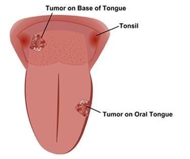 Tưởng viêm niêm mạc lưỡi, người đàn ông &quot;sốc&quot; khi bác sĩ chẩn đoán ung thư  第1张