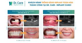 Dr. Care - địa điểm trồng răng Implant cho người trung niên tại TPHCM  第5张